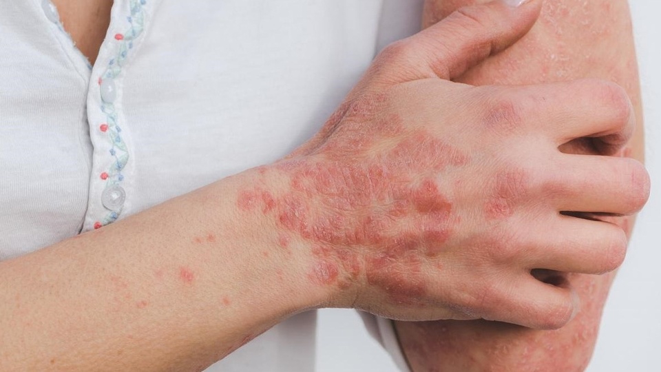 Các bệnh ngoài da thường gặp nhất hiện nay