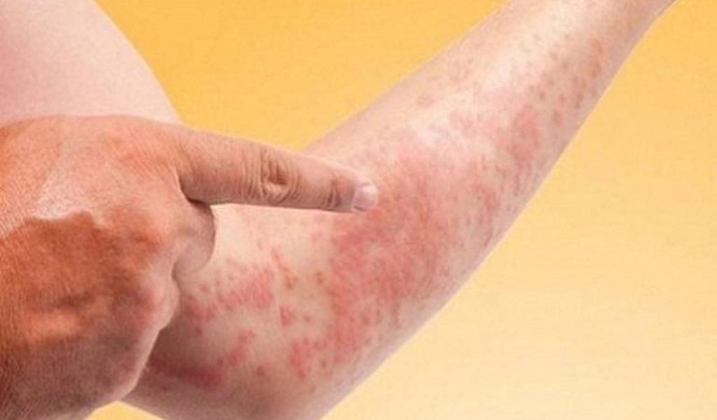 Làm thế nào để phòng ngừa và giảm nguy cơ mắc các bệnh ngoài da phổ biến?
