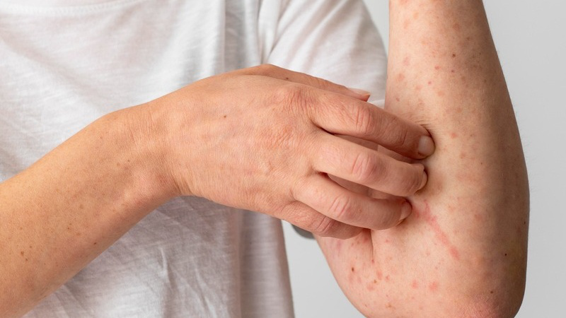 Các bệnh về da mùa hè thường gặp và cách phòng ngừa 1