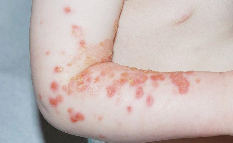 Các bệnh về da mùa hè thường gặp và cách phòng ngừa 3