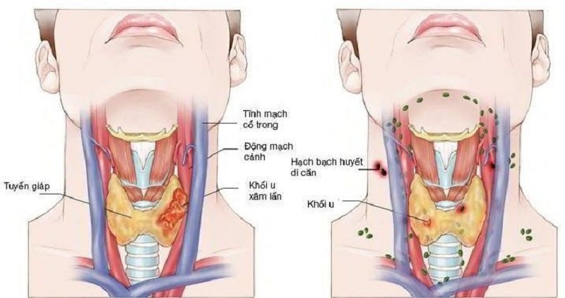 Các bệnh về họng thường gặp và cách điều trị  1