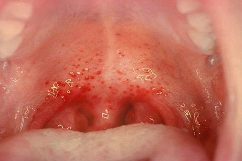 Các bệnh về họng thường gặp và cách điều trị  4
