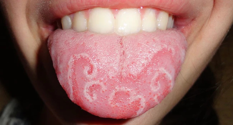 Các bệnh về lưỡi ở trẻ em thường mắc phải, mẹ đã biết? 3