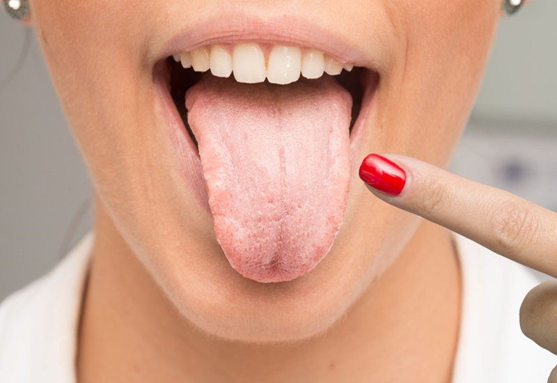Các bệnh về lưỡi thường gặp: Nguyên nhân, triệu chứng và hướng điều trị 3