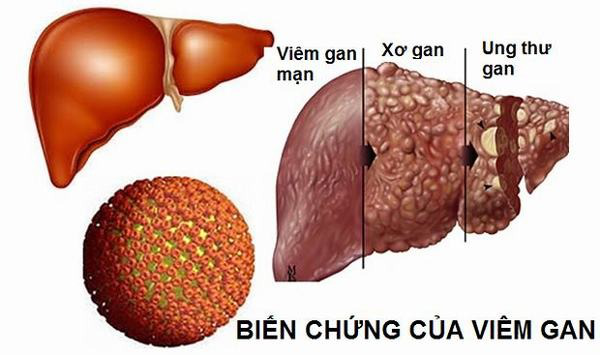 Các biến chứng thường gặp của bệnh viêm gan 2