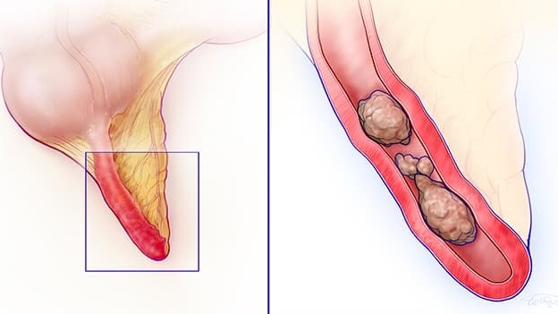 Các giai đoạn của viêm ruột thừa? Điều trị viêm ruột thừa như thế nào?