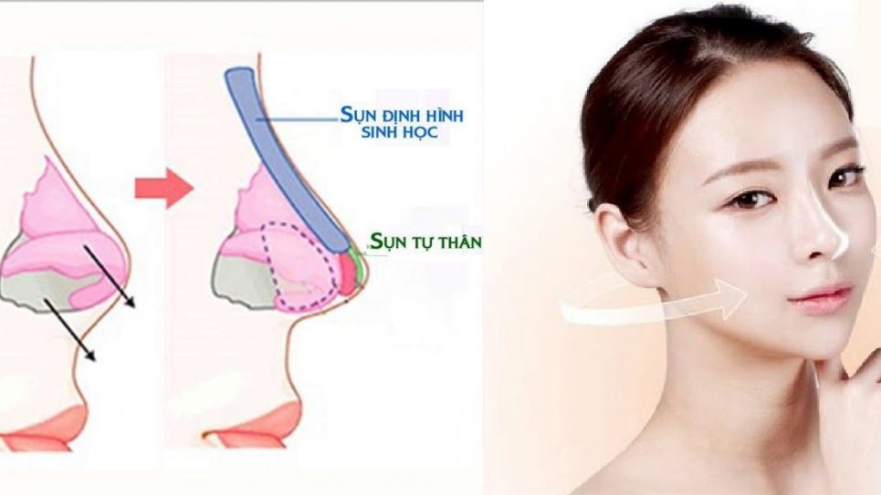 Các loại sụn nâng mũi​ phổ biến hiện nay bạn nên biết - Nhà thuốc FPT Long  Châu
