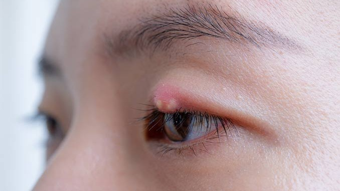 Có những lưu ý gì khi sử dụng thuốc nhỏ mắt trị lẹo của Nhật? 
