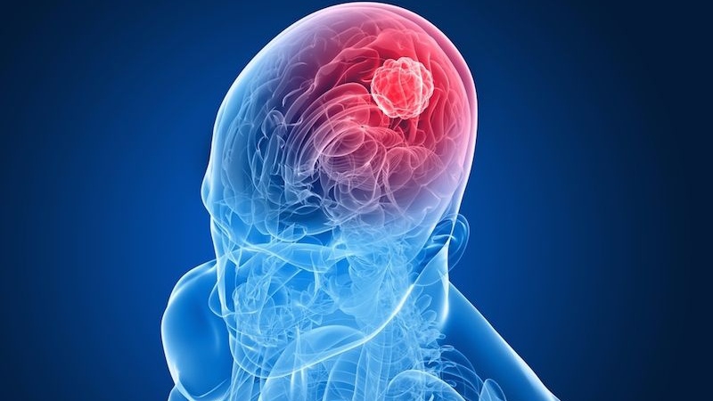 Các loại u não thường gặp và nguyên nhân gây ra các khối u não