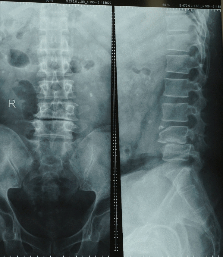 Các phương pháp điều trị gai cột sống 2