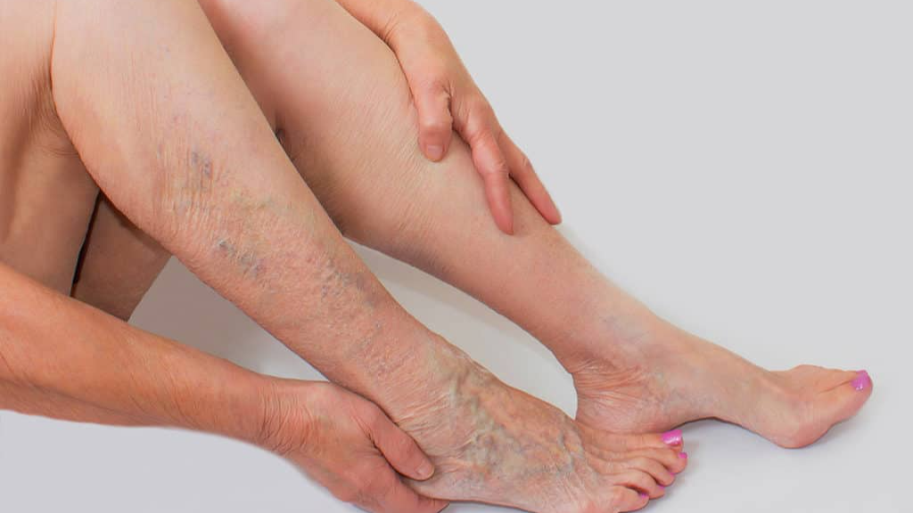 Các triệu chứng giãn tĩnh mạch không nên bỏ qua