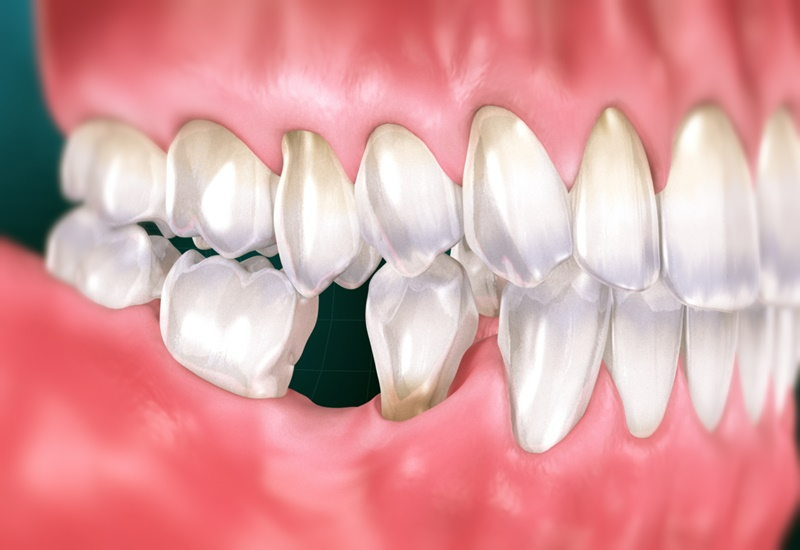 Các trường hợp chấn thương răng và cách xử lý1