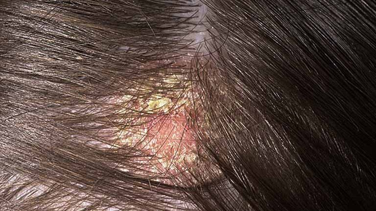 Bệnh chàm da đầu là gì?
