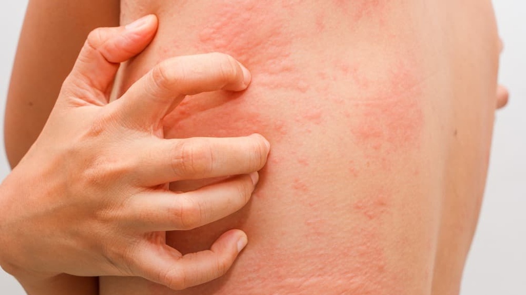 Hết nổi mề đay hiệu quả với dung dịch xịt ngoài da Skin Herbal