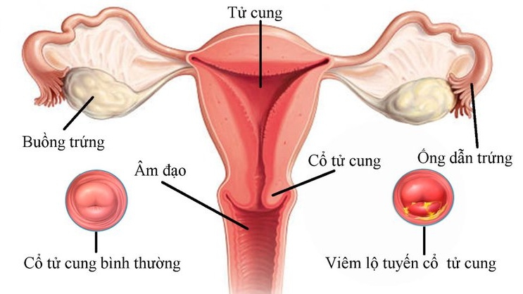 Cách sử dụng thuốc thoa để chữa trị viêm lộ tuyến cổ tử cung như thế nào?
