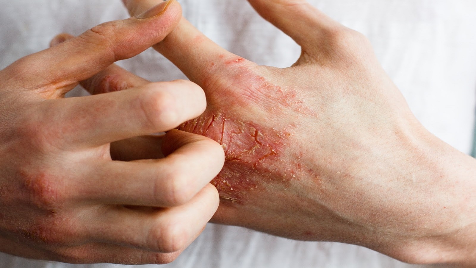 Có những rủi ro nào khi sử dụng kháng sinh để điều trị viêm da?
