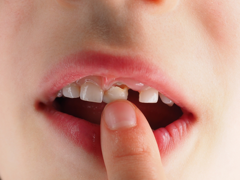 Làm thế nào để tránh nhiễm trùng sau khi nhổ răng sữa tại nhà?
