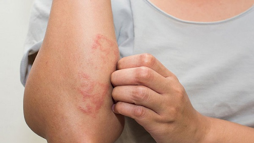 Cách sơ cứu bỏng độ 1 đơn giản bạn đã biết chưa?