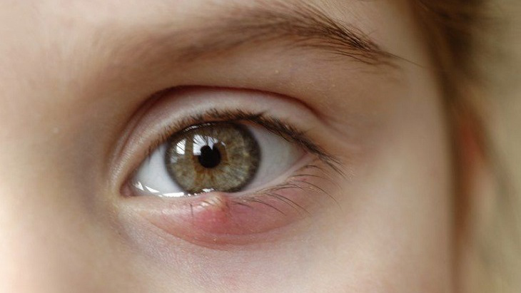 Phương pháp chữa lẹo mắt bằng cột chỉ có hiệu quả không?
