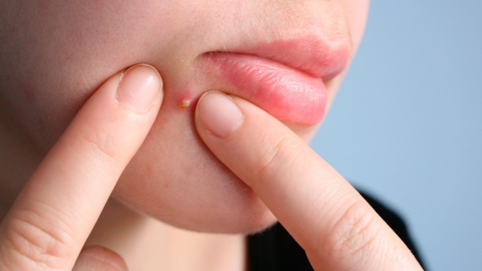 Cách chăm sóc da mép môi để tránh mụn xuất hiện?
