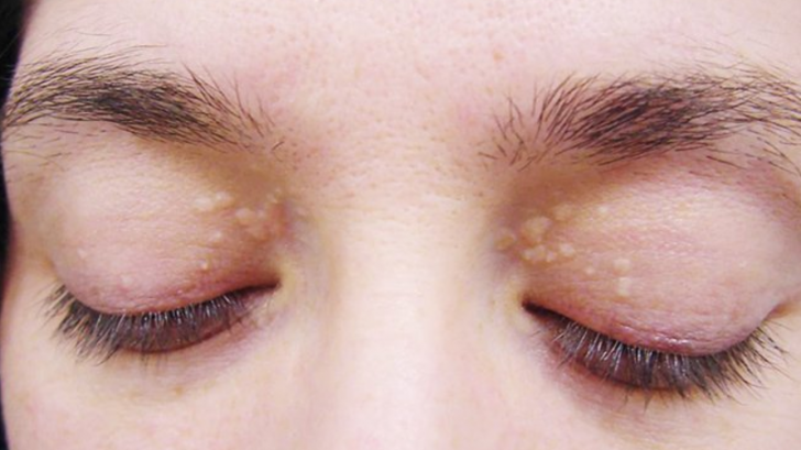 Thuốc trị mụn thịt quanh mắt có thể được sử dụng cho mọi loại da không?

