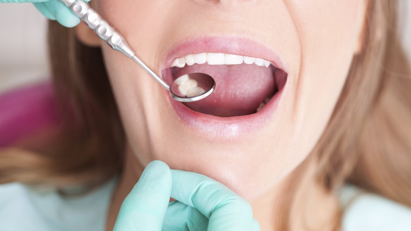 Cần súc miệng bao nhiêu lần mỗi ngày sau khi nhổ răng khôn?
