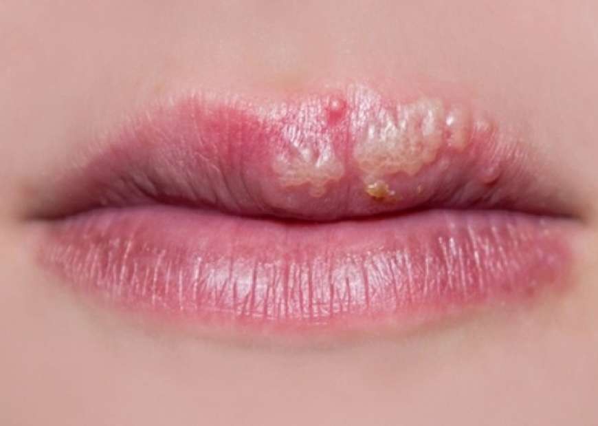 Trong những đối tượng nào thường xảy ra bệnh zona ở miệng?
