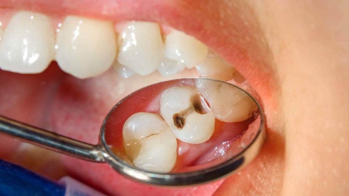 Nên tham khảo ý kiến chuyên gia nha khoa trước khi tự chữa trị sâu kẽ răng cửa tại nhà như thế nào?
