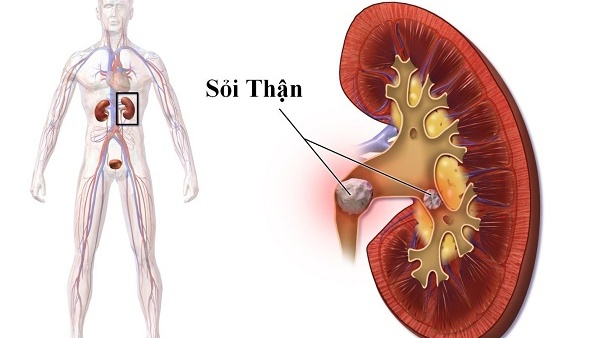 Cặn thận có thể biến thành sỏi thận không? 