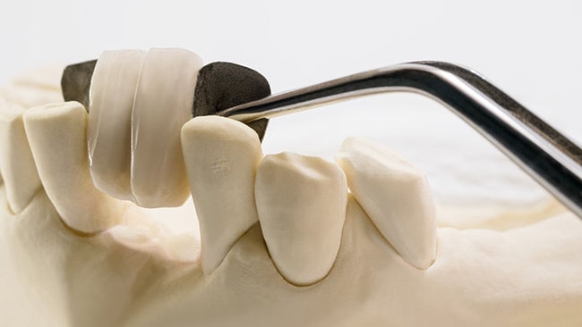 Tìm hiểu các phương pháp trồng răng phổ biến hiện nay 7
