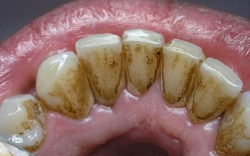 Cạo vôi răng là gì? Giá cạo vôi răng hiện nay là bao nhiêu?