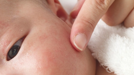 Cập nhập danh sách thuốc bôi dị ứng da mặt cho bé tốt nhất