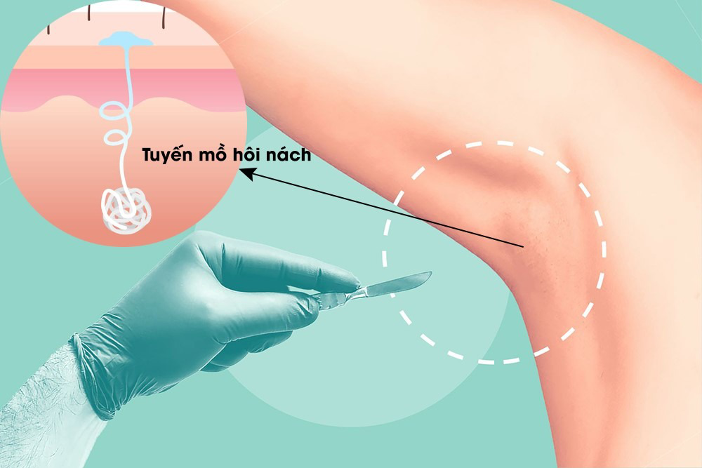 Cắt tuyến mồ hôi nách có đau không? Và những điều cần lưu ý