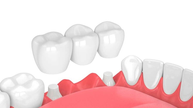 Cầu răng sứ và implant: Nên chọn phương pháp nào? So sánh chi tiết 1