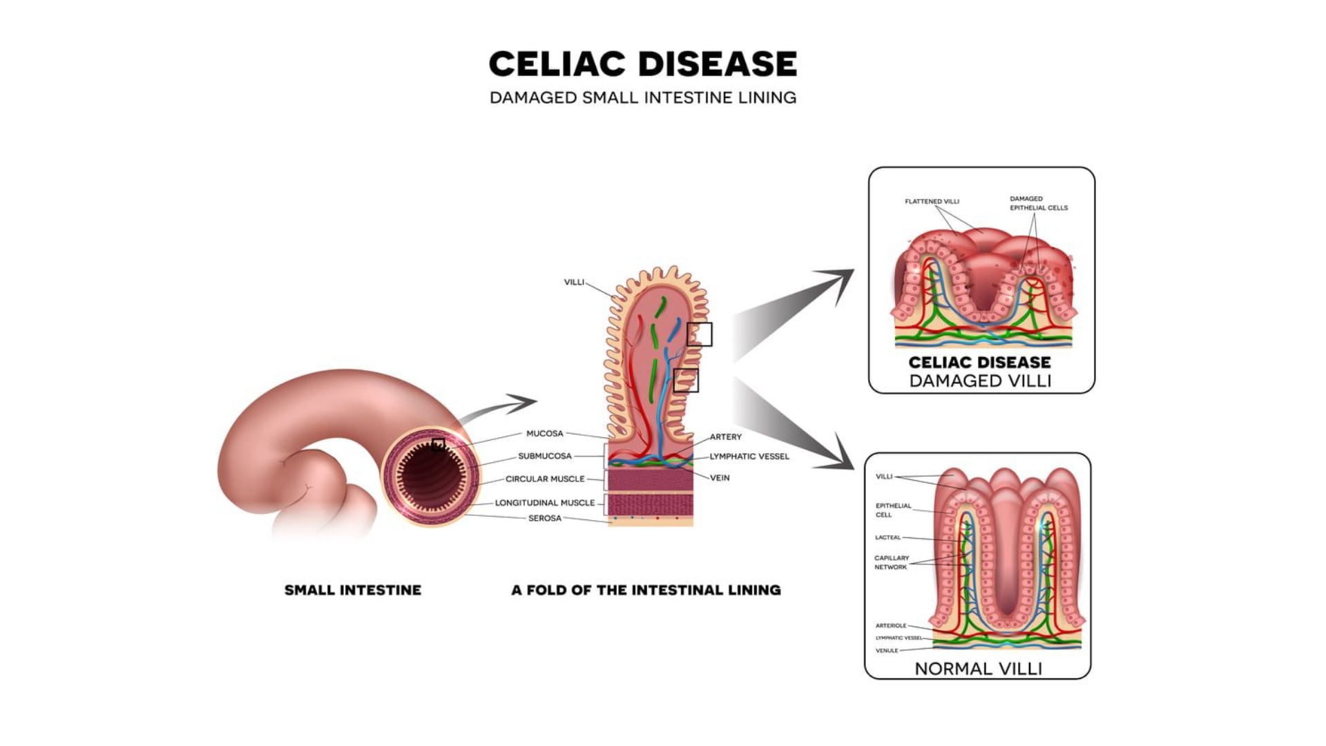 Lợi ích khi kiểm soát bệnh Celiac