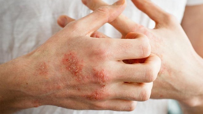 Chữa bệnh chàm khô ở tay hiệu quả như thế nào?
