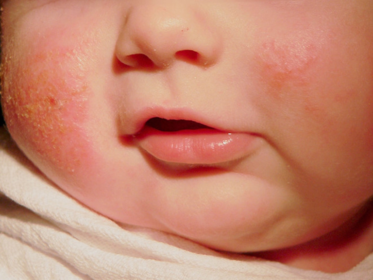 Bệnh eczema ở trẻ sơ sinh có thể tự giảm đi sau một thời gian không?
