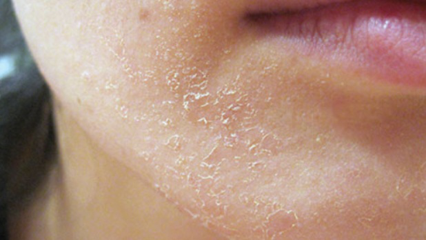 Bệnh chàm da khô có nguyên nhân gì?
