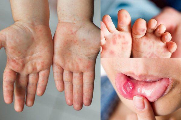 Chân tay miệng có dùng kháng sinh không? Các cách phòng ngừa bệnh 2