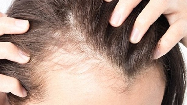 Điều gì gây chân tóc yếu và dễ gãy rụng?
