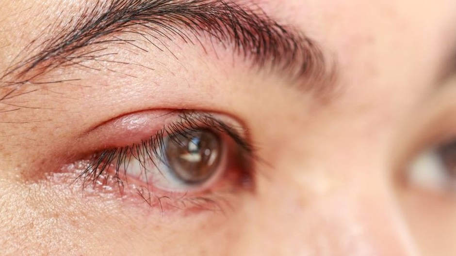 Có tồn tại nguy cơ mắt bị sẹo hay mất thẩm mỹ sau khi chắp mắt để lâu không?
