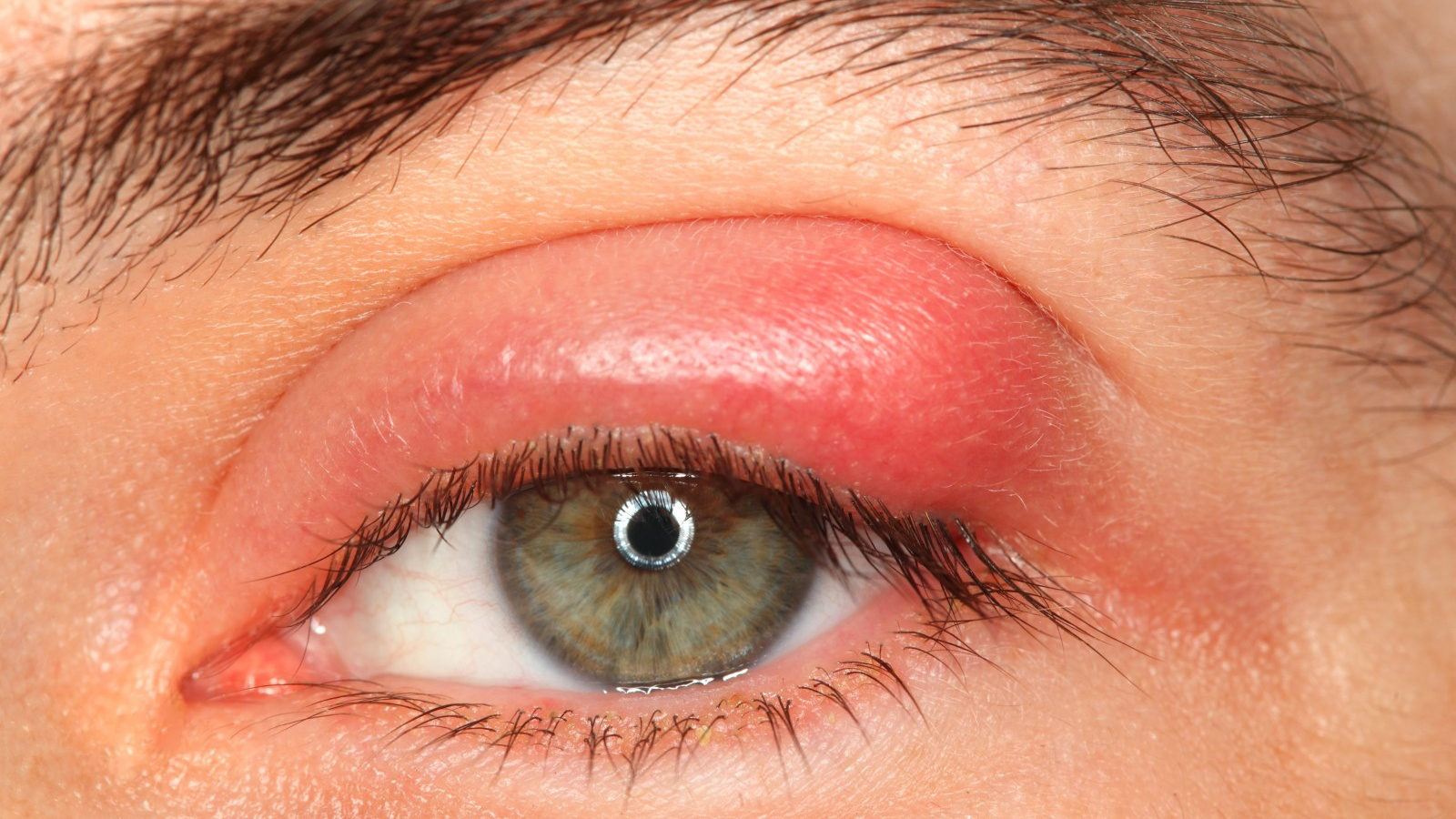 Nguyên nhân gây chắp mắt tái phát nhiều lần là gì?
