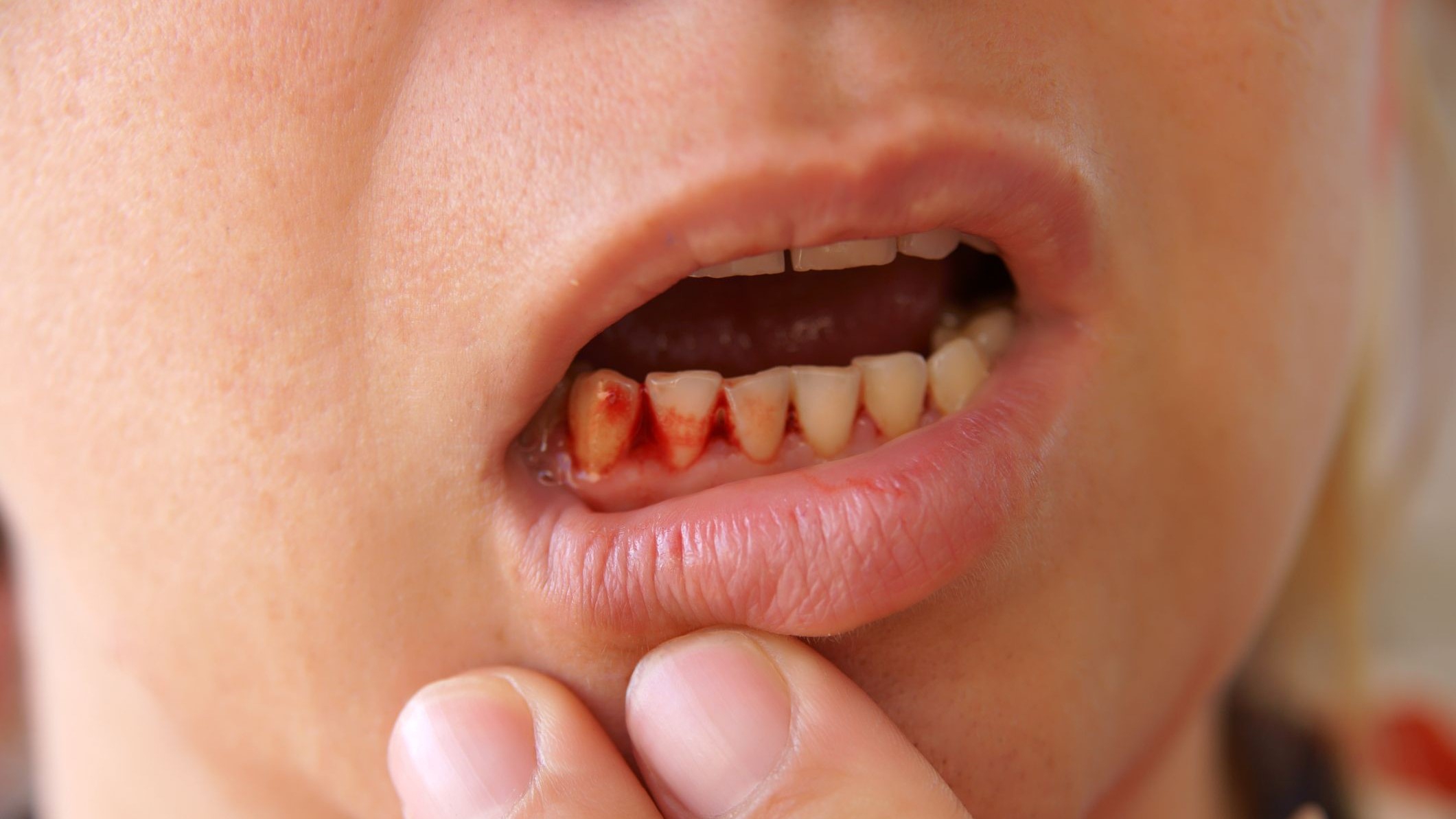 Làm thế nào để ngừng chảy máu răng không cầm được?