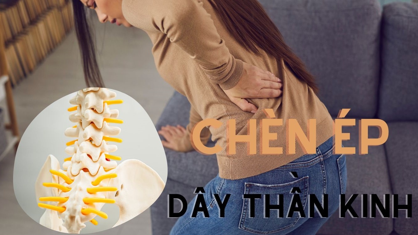 Tình trạng chèn ép dây thần kinh là gì? Cách nhận biết và phòng ngừa