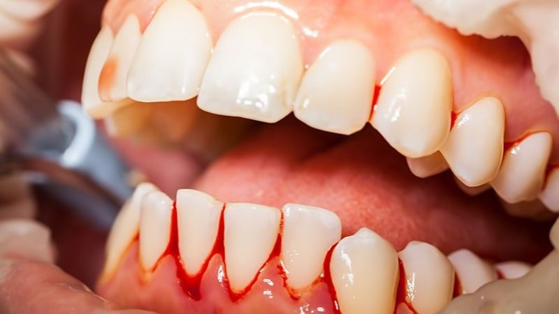 Chép miệng, chảy máu chân răng phải làm sao? 1