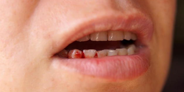 Chép miệng, chảy máu chân răng phải làm sao? 2