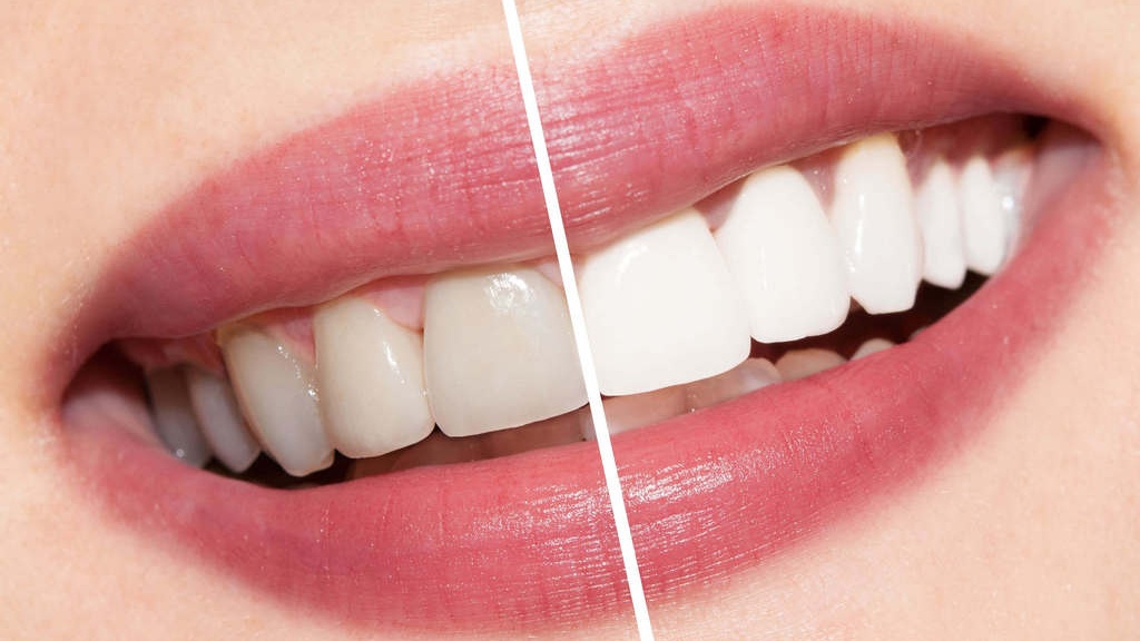 Tại sao vỏ chuối có tác dụng làm trắng răng?
