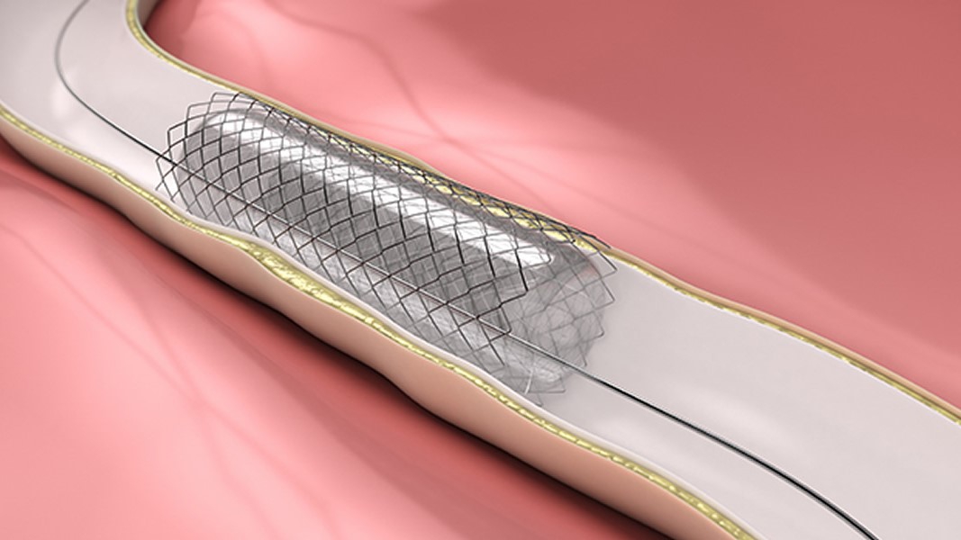 Chi phí đặt stent mạch cảnh là bao nhiêu?