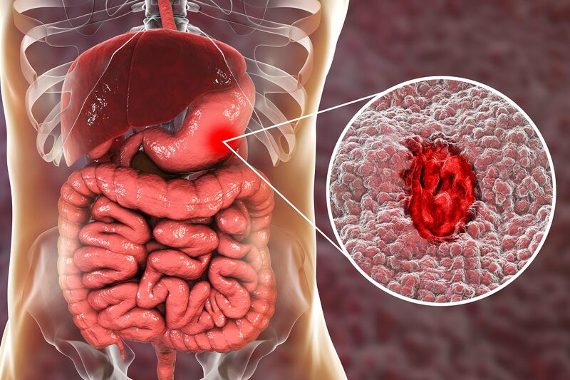 Chỉ số pH dạ dày là gì? Công dụng và những vấn đề cần lưu ý 3