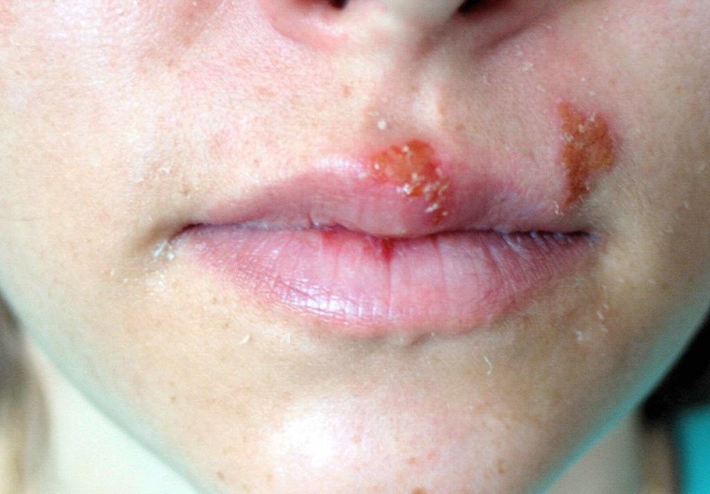 Có những dấu hiệu gì khác có thể nhận biết bệnh giời leo ở miệng?
